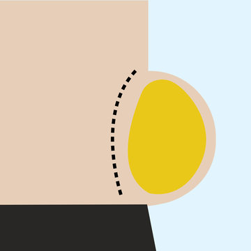 vector of obease belly