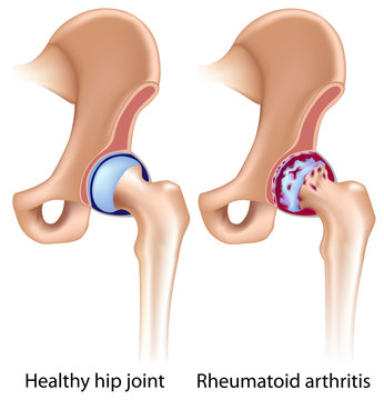 Rheumatoid Arthritis Of Hip Joint