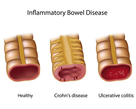 Comparing inflammatory bowel disease