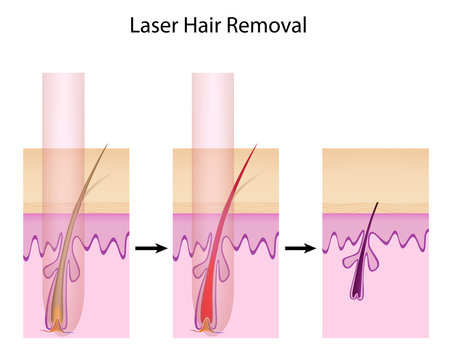 Laser hair removal procedure