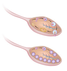 Polycystic ovary syndrome, unlabeled. 