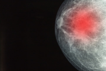 Mammography x'ray picture.