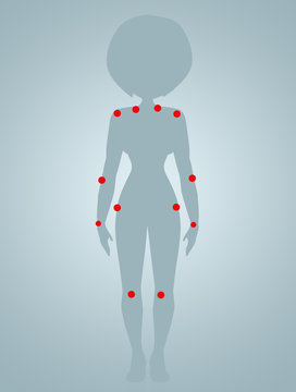 Illustration Of Fibromyalgia