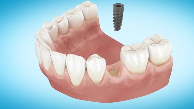 Beautiful Tooth implant installation process. Close Up 3d Animation. Full HD 1920x1080.