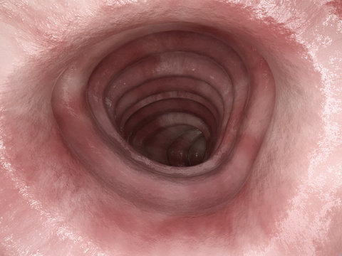Colitis ulcerosa - Stage 0 - 3D rendering