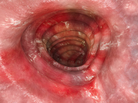 Colitis ulcerosa - Stage 3 - 3D rendering