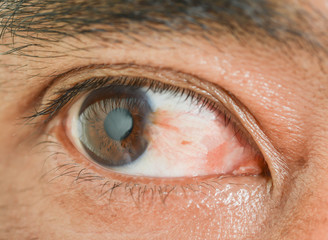 Eye pterygium in old women