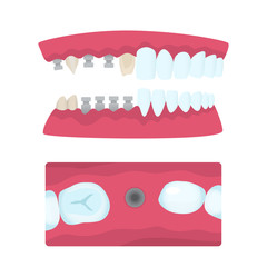 Dental crowns and implantation