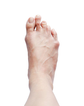 Right bunion - hallux valgus on white background and clipping path