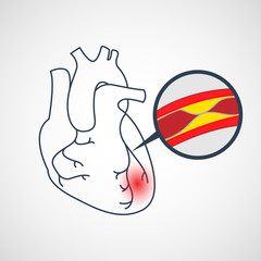 Obraz premium Coronary Artery Disease vector icon illustration