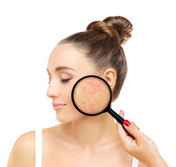 Post-Acne Marks /Treating Acne Scars
