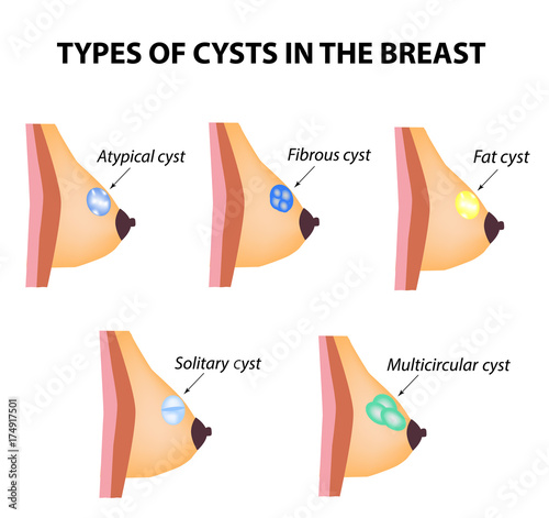 picture of breast cysts Episodes of blazing teen 2