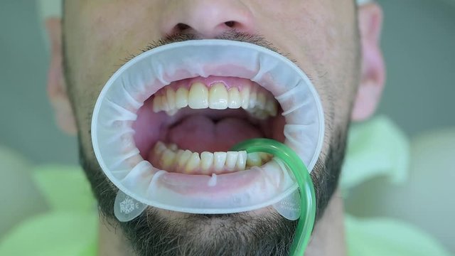 Patient with an expander in the mouth. Dental office.