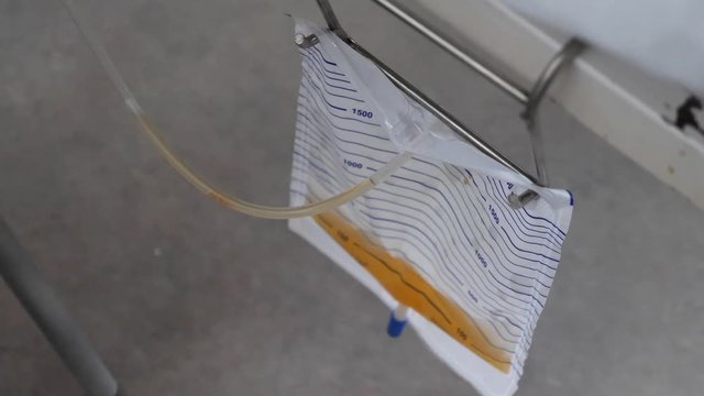 Footage of a catheter bag hanging on the edge of a patients bed in a hospital...