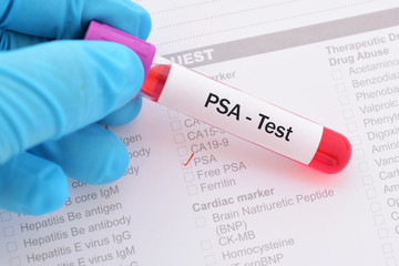 Blood sample for PSA (prostate specific antigen) test, diagnosis for prostate cancer