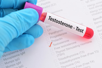 Blood sample for testosterone hormone test