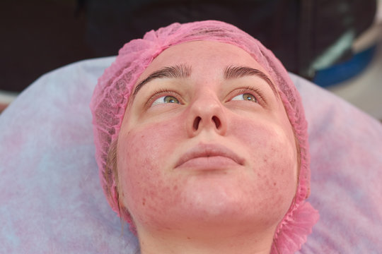 Face of young woman, acne. Beauty clinic patient close up. Skin infections guidelines.