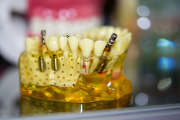 Transparent Model of Human Teeth with implants close-up