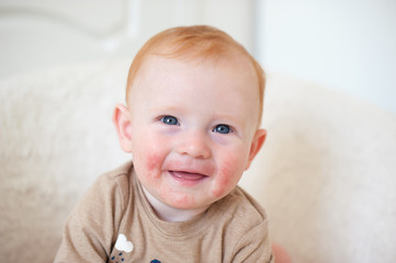 Manifestation of an allergy on the face of the child