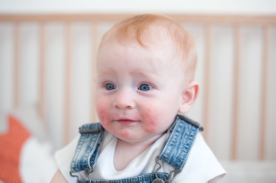 Surprised child with atopic dermatitis