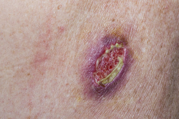 Wound dehiscence - open wound from unsuccessful medical stitches after the removal of a basal cell carcinoma