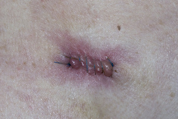 Post Operative Stitches for the removal of a Basal Cell Carcinoma 