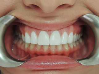 Fototapeta premium Close up of a patient's mouth at a dental clinic