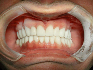Close up of a patient's mouth at a dental clinic