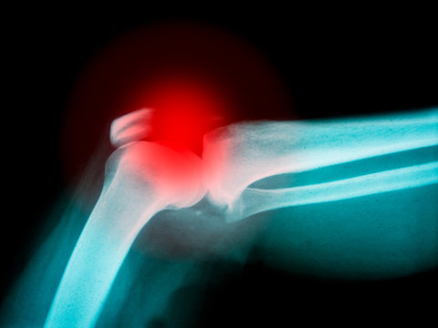 Arm X-ray with highlight on broken bone