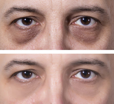 Dark eye circles treatment - BEFORE and AFTER
