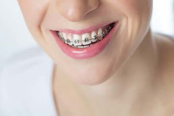 Obraz premium Woman in braces 