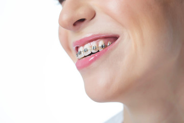 Woman in braces 