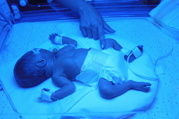 Mother hand touching her baby son in incubator (neonatal intensive care unit). Child baby having a treatment for jaundice under ultraviolet light phototheraphy in incubator.                    © Petr Bonek