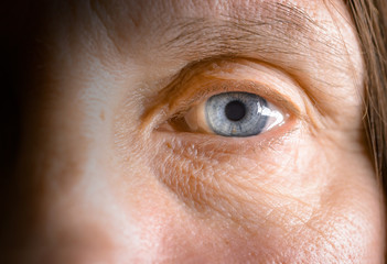 Close up of a woman's blue eye with a hard contact lens