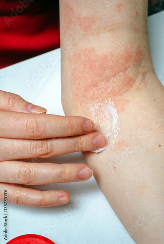 Backpulver Gegen Ekzeme  Modifymyscion Com Backpulver Gegen Ekzeme  Modifymyscion Com