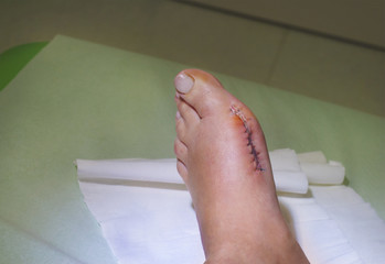 Patient after the bunion operation of Hallux Valgus
