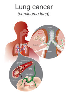The Lung cancer is a malignant lung tumor characterized by uncontrolled cell growth in tissues of the lung. Lung system, Respiratory system. Illustration graphic.