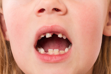 Kind mit Zahn lücke