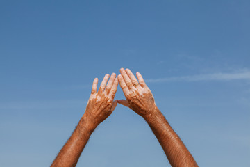 Hands with Vitiligo Skin Disease
