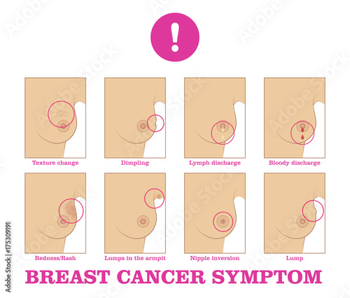 warning signs cancer pain breast