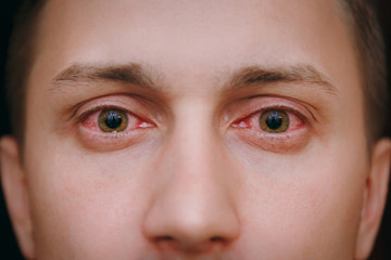 Close up of two annoyed red blood eyes of a man affected by conjunctivitis