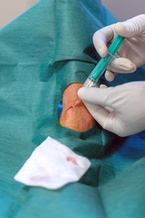 point de suture