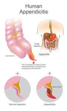 Human Appendicitis. A blocked by a piece of stool thereby blocking it is contents from emptying into intestines. Large Intestine system. Illustration human body parts.