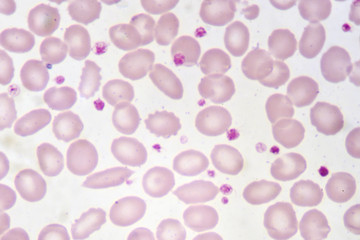Red blood cells and platelet in blood smear
