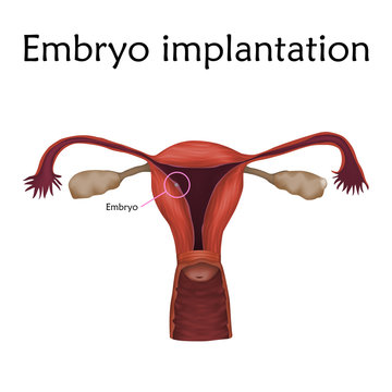 1613328 Embryo implantation. The fertilized egg, uterus, womb. Anatomy illustration. White background.