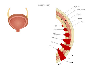 bladder cancer in its various stages, according to the TNM staging system.