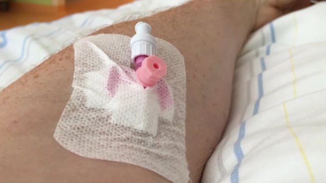 Kan&uuml;le, Venenverweilkan&uuml;le im Arm 