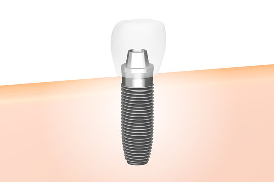 Dental implant/ tooth implant