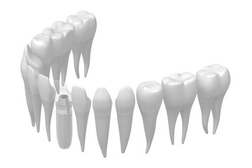 Dental implant/ tooth implant