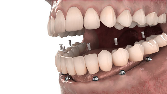 Dental anatomy - Lower jaw implant overdenture 